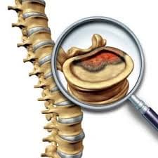 Spine Tumor spine condition treatment in Miraj Maharashtra